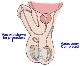 Vasectomy Picture
